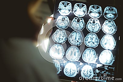 Brain MRI and dementia Stock Photo