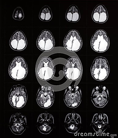 Brain mri showing enlarged ventricles Stock Photo