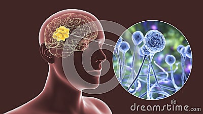 Brain mucormycosis, a brain lesion caused by fungi Mucor Cartoon Illustration