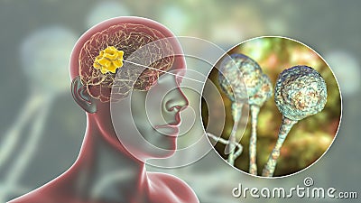 Brain mucormycosis, a brain lesion caused by fungi Mucor Cartoon Illustration