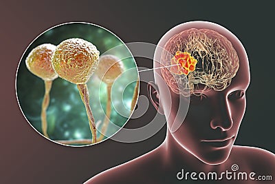 Brain mucormycosis, a brain lesion caused by fungi Mucor, also known as black fungus Cartoon Illustration