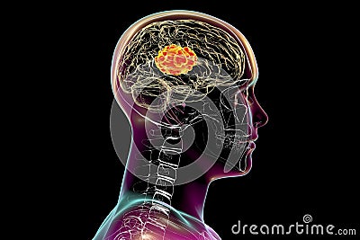 Brain mucormycosis, a brain lesion caused by fungi Mucor, also known as black fungus Cartoon Illustration