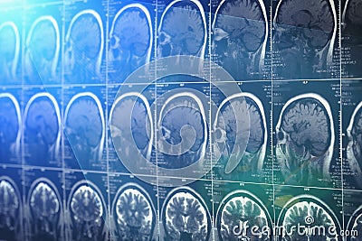 Brain scan, MRI or X-Ray. Neurology tomography concept Stock Photo