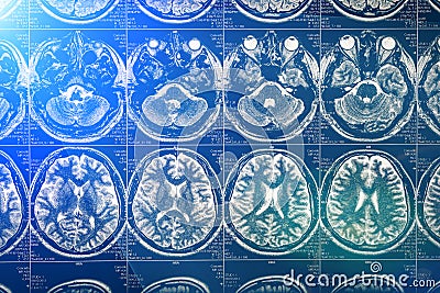 Brain scan X-ray Mri or Magnetic resonance imaging of human head, neurology concept Stock Photo