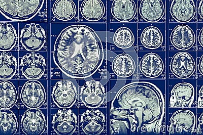 Brain scan X-ray Mri or Magnetic resonance imaging of human head, neurology concept Stock Photo