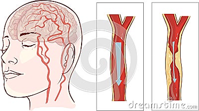 Brain stroke. Cerebral infarction Vector Illustration