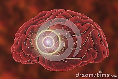 Brain stroke concept Cartoon Illustration