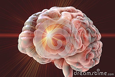 Brain stroke, headache conceptual image Cartoon Illustration