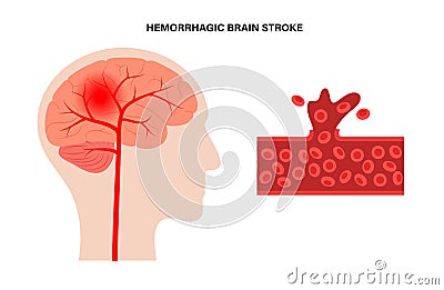 Brain stroke hemorrhagic Vector Illustration