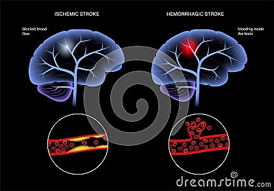 Brain stroke ishemic and hemorrhagic Vector Illustration