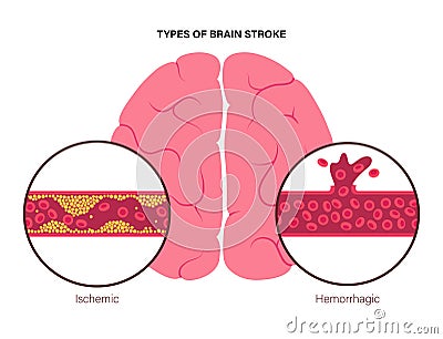 Brain stroke ishemic and hemorrhagic Vector Illustration