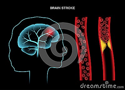 Brain stroke ishemic Vector Illustration