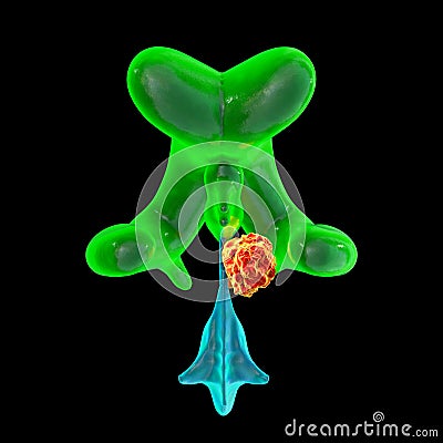 A brain tumor causing hydrocephalus, 3D illustration Cartoon Illustration