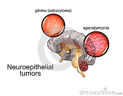 Brain tumour 2, neurosurgery Vector Illustration