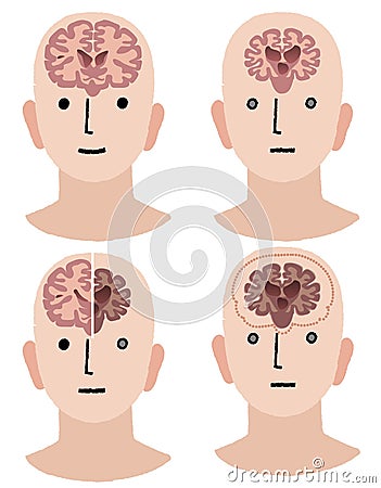 Brains of Dementia and Healthy man Vector Illustration