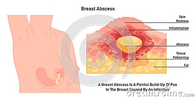 Breast abscess. Cross-section of the female chest with inflammation Vector Illustration