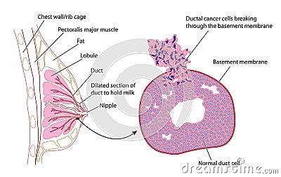 Breast Cancer Vector Illustration