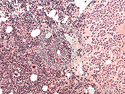 Breast cancer. Bone marrow metastases. Stock Photo