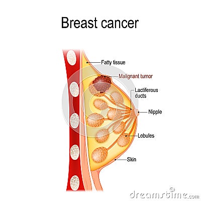 Breast cancer. Cross-section of the mammary gland with tumor Vector Illustration