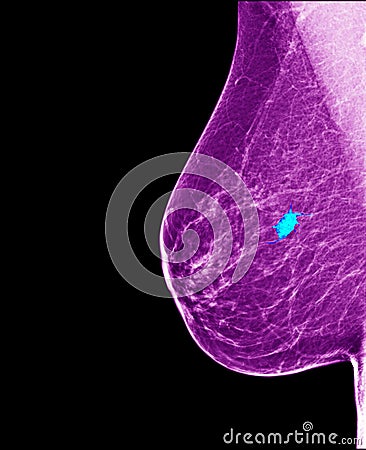 Breast cancer - mammogram Stock Photo