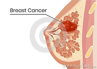 Breast cancer structure. Vector illustration of the lobular carcinoma Vector Illustration