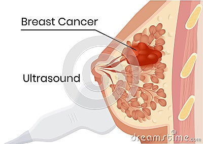 Breast cancer ultrasound. Vector illustration of the breast carcinoma screening Vector Illustration