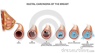 Breast carcinoma Vector Illustration