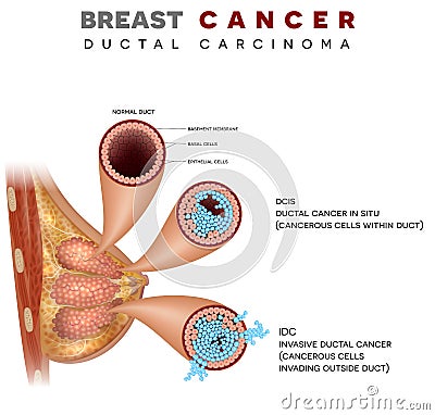 Breast Ductal cancer Vector Illustration