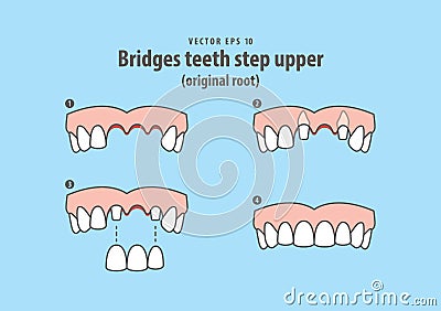 Bridges teeth step upper original root illustration vector on Vector Illustration