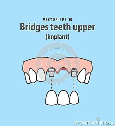 Bridges teeth upper implant illustration vector on blue backgr Vector Illustration