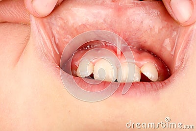 The bridle of the upper lip in the child close up Stock Photo