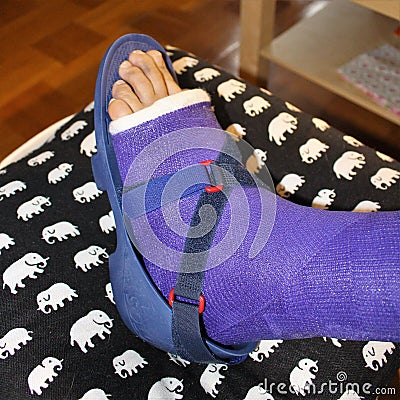 A broken ankle with purple plaster Editorial Stock Photo