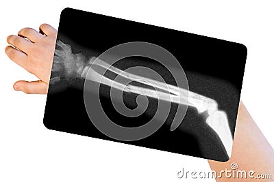 Broken arm Stock Photo