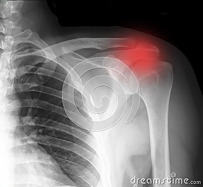 Broken bone xray Stock Photo