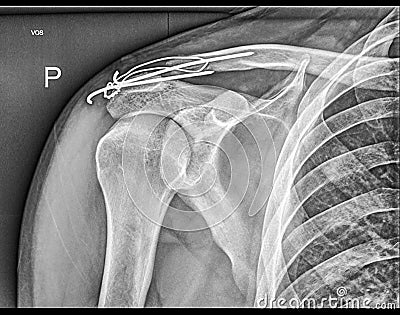 Broken clavicle bone fixation, Fracture repair Stock Photo