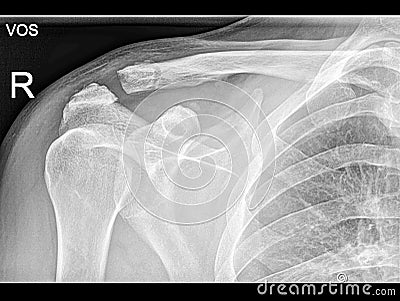 Broken clavicle bone fixation, Fracture repair Stock Photo