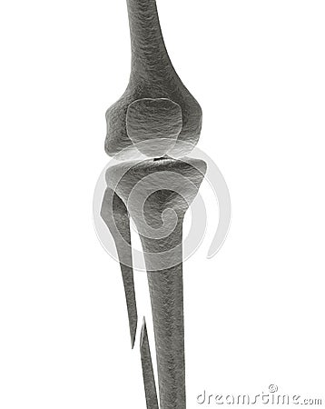 Broken Leg Bone X-ray Stock Photo