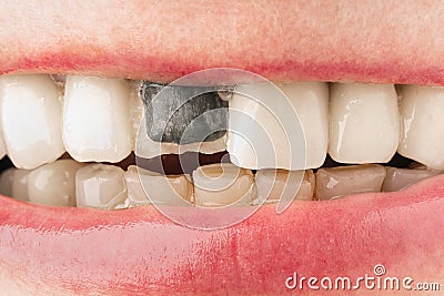 Broken metal-ceramic front tooth in female mouth Stock Photo