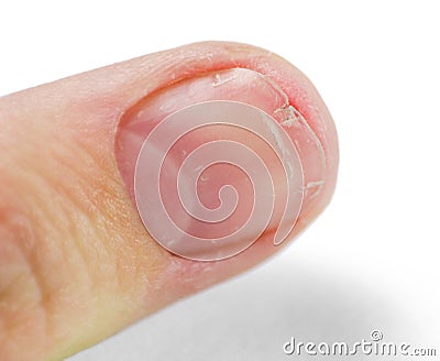 A broken nail on his thumb. Close up. Isolated on white background Stock Photo