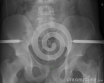 Broken pelvis Stock Photo