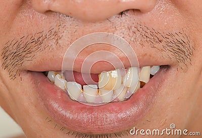 Broken teeth Damaging and ugly Stock Photo