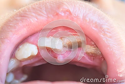 Close up tooth loss in children Stock Photo