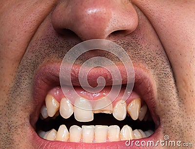 Broken tooth. Broken upper incisor in a man mouth. Stock Photo