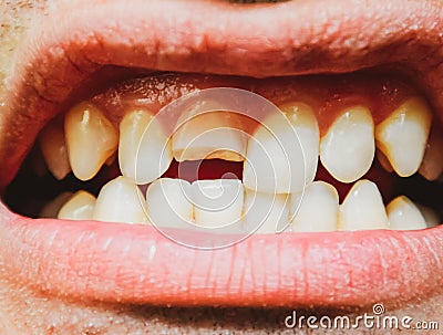 Broken tooth. Broken upper incisor in a man mouth Stock Photo