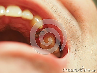 Broken tooth with only root remaining Stock Photo