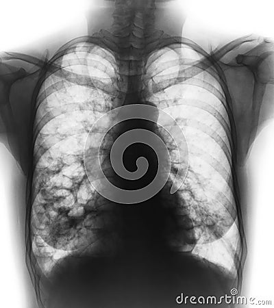 Bronchiectasis . X-ray chest show multiple lung bleb and cyst due to chronic infection . Front view Stock Photo