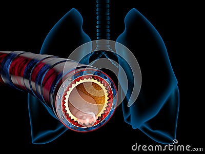 Bronchitis anatomy, mucus secreted as a chest cold as a 3D illustration Cartoon Illustration