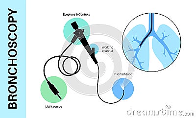 Bronchoscopy procedure concept Vector Illustration