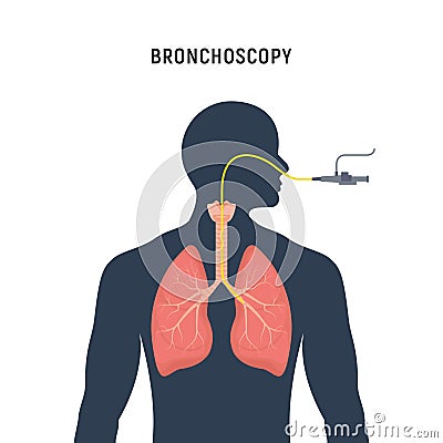 Bronchoscopy respiratory system emphysema endoscopy human lung examination. Bronchoscopy icon Vector Illustration