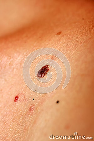 Brown birthmark. Brown mole large size. Stain on the skin Stock Photo